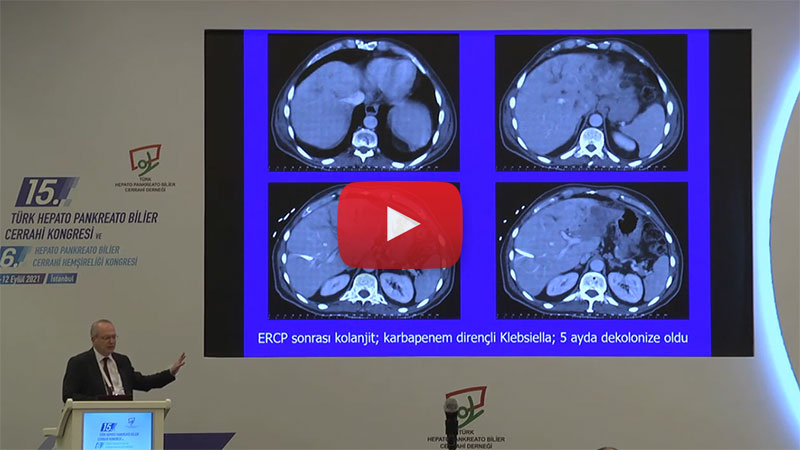 Perihiler kolanjiokarsinomda cerrahi tedavi: Doğu ve Batı yaklaşımları.